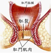 肛裂便血